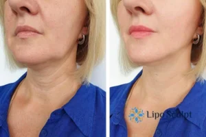 Book your double chin treatment Bellshill today! We are here to help!