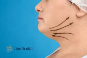 Boost your confidence with a Double chin treatment Bellshill 