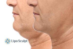 Double chin treatment Bellshill from Lipo Sculpt - feel more confident today!