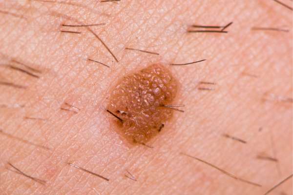 seborrheic keratosis removal