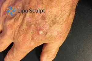 Improve your wellbeing and health with Actinic Keratoses Bellshill removal.treatment