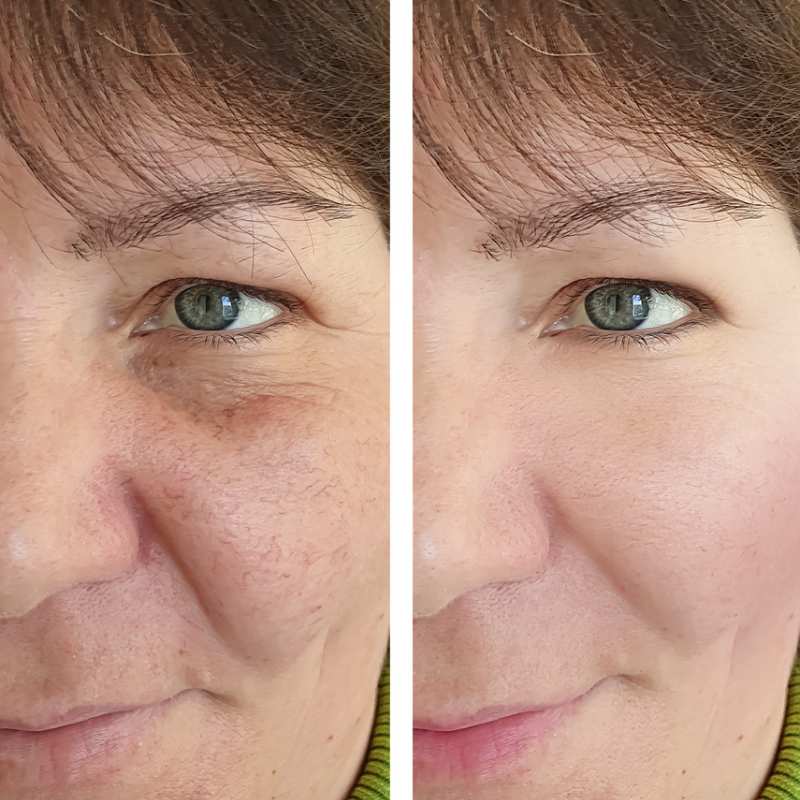 hifu before and after