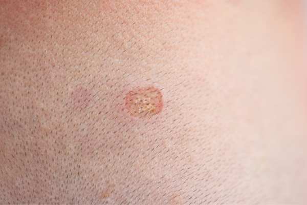 Porokeratosis removal