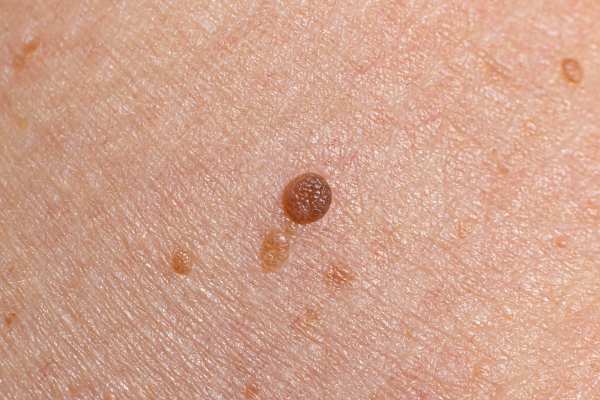 benign mole removal