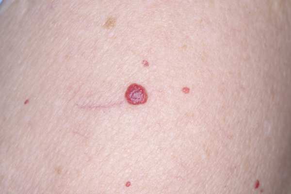 cherry angioma removal