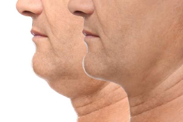Book your Chin Reduction Treatment Bellshill today!