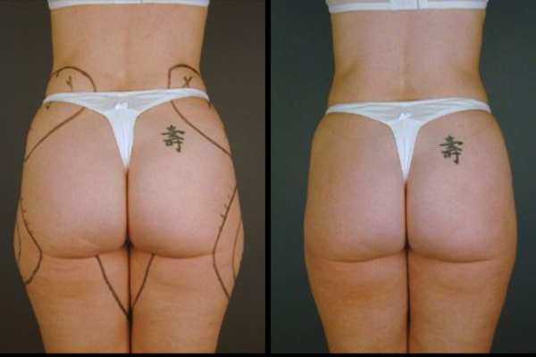 before and after