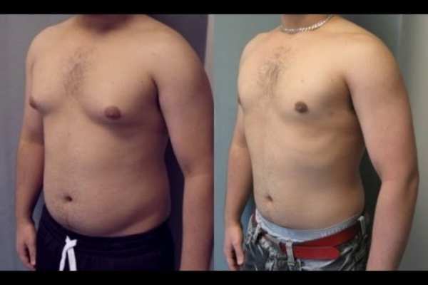 cryolipolysis before and after 2