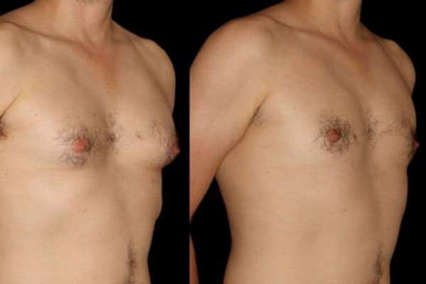 cryolipolysis before and after 3
