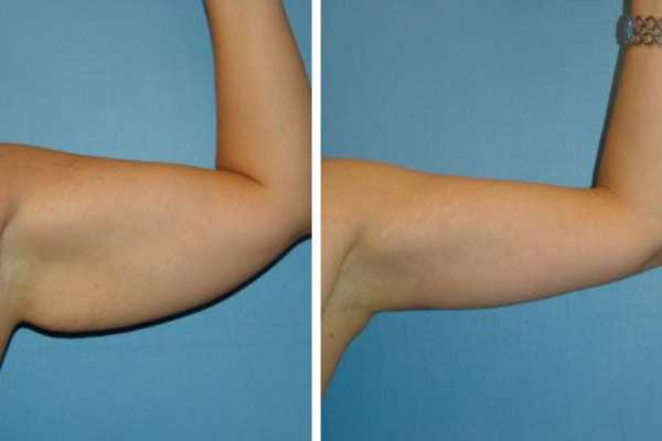 cryolipolysis before and after 4