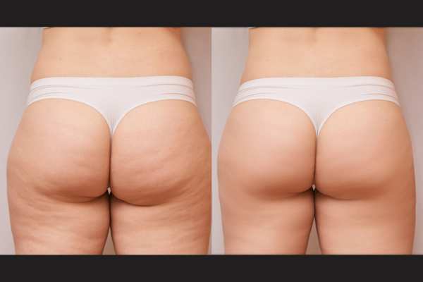 cryolipolysis before and after 5