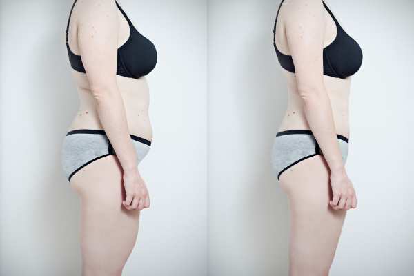 cryolipolysis before and after 7