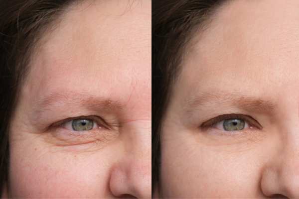 hifu before and after 7