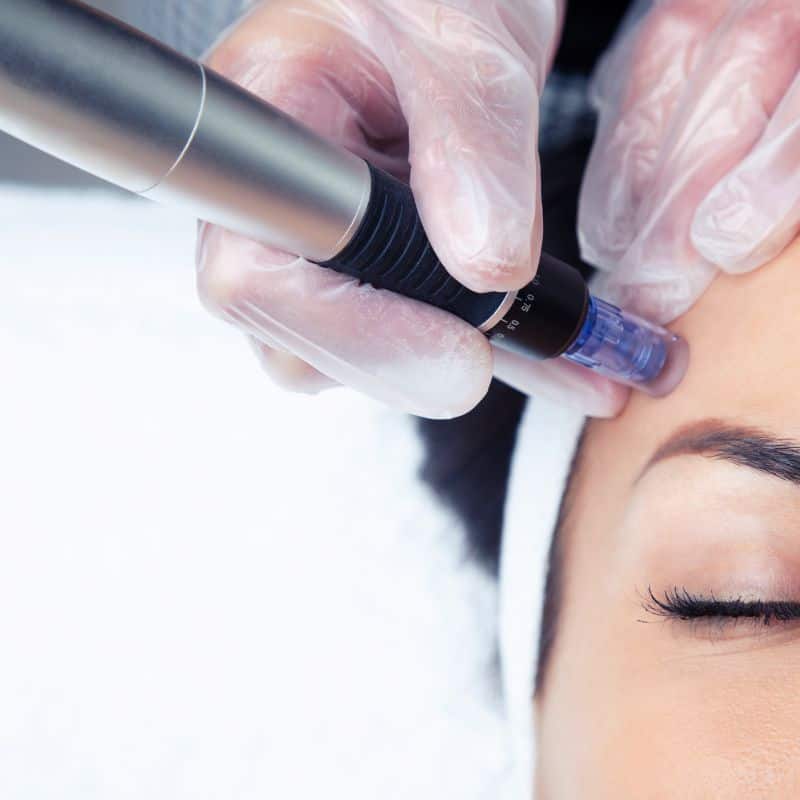 Morpheus8 treatment Bellshill from Lipo Sculpt - Book in today!