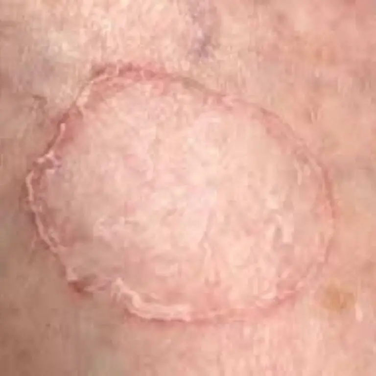 Porokeratosis-Removal