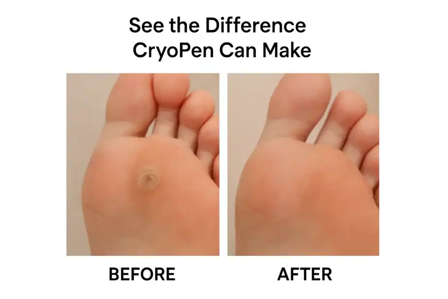 Before and after Cryopen