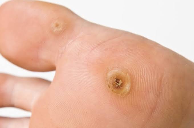 What happens during CryoPen verruca removal?