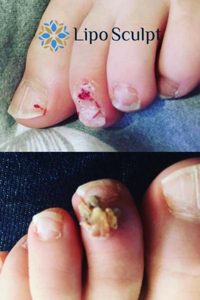 Wart removal customer results from Lipo Sculpt Bellshill