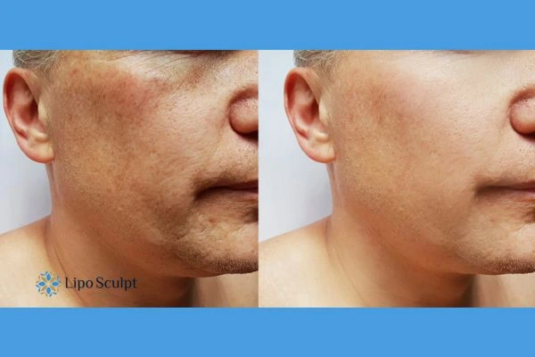Get your Morpheus8 treatment Bellshill booked in today!