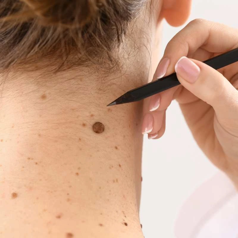 See our lesion removal prices Bellshill - call today for a free quote