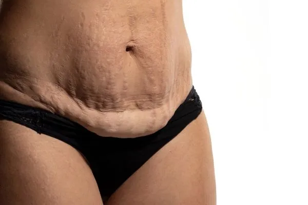 Lost the Weight but Not the Loose Skin? 1 image of womans stomach after weight loss showing loose skin Bellshill