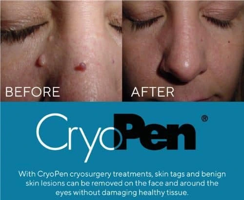 image of angiofibroma removal Bellshill using Lipo Sculpt cryopen!