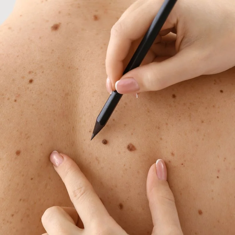cryopen lesion removal treatment Bellshill