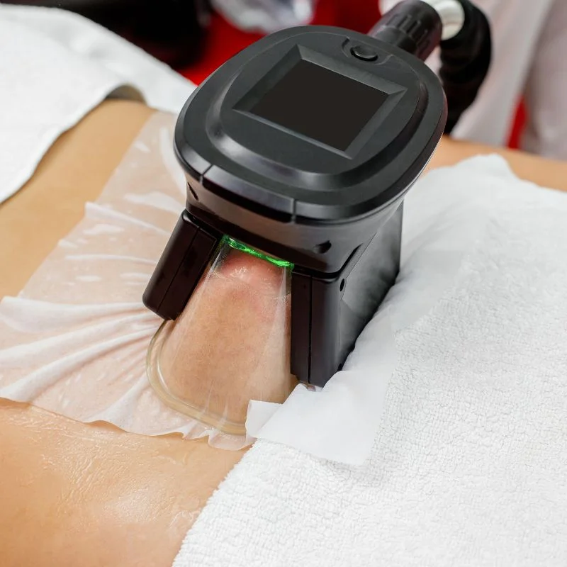 Fat Freezing treatment Bellshill